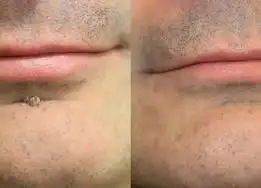 2-in-1 Microneedle & Hydrocolloid Patch - Image 10