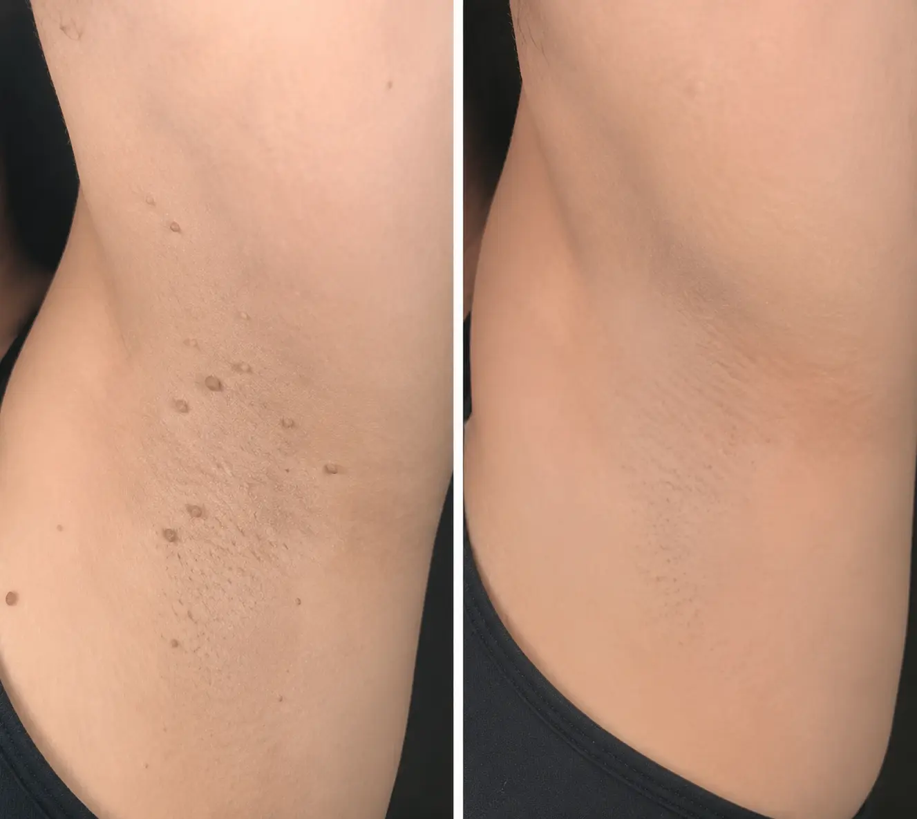 2-in-1 Microneedle & Hydrocolloid Patch - Image 7