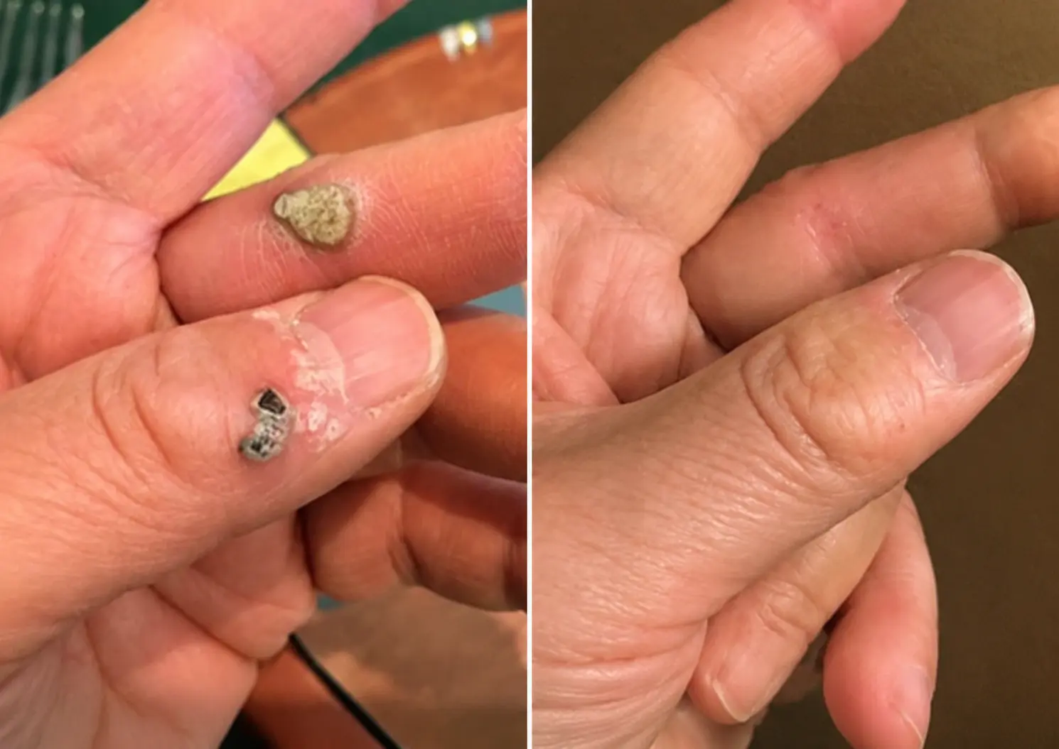 2-in-1 Microneedle & Hydrocolloid Patch - Image 8