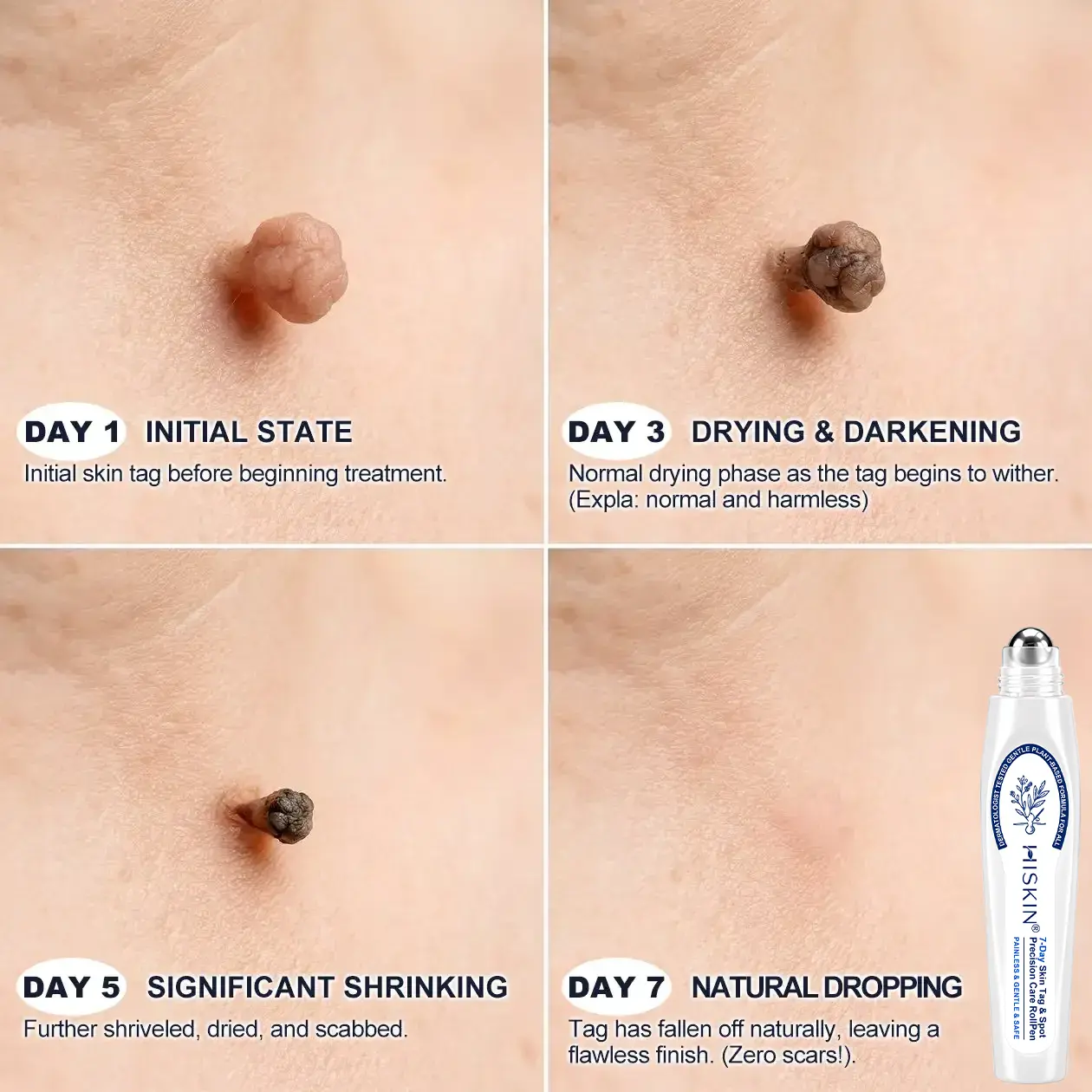 Clinical Wart Removal Patch - Image 4