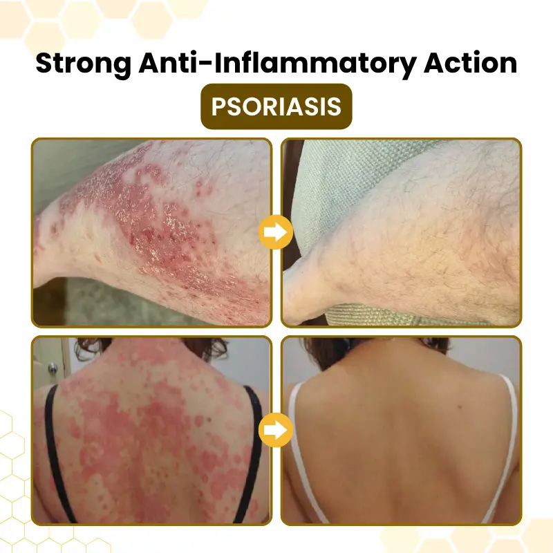 PsoriaSoothe Bee Venom Skin-Restoration Cream - Image 2