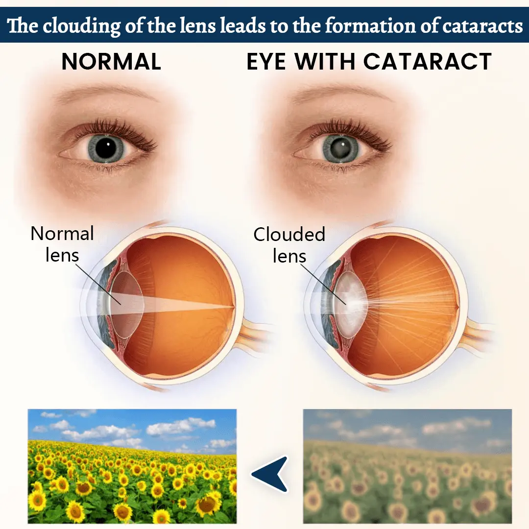 Relieflogix OptiFusion Vision Support Eye Patch - Image 5