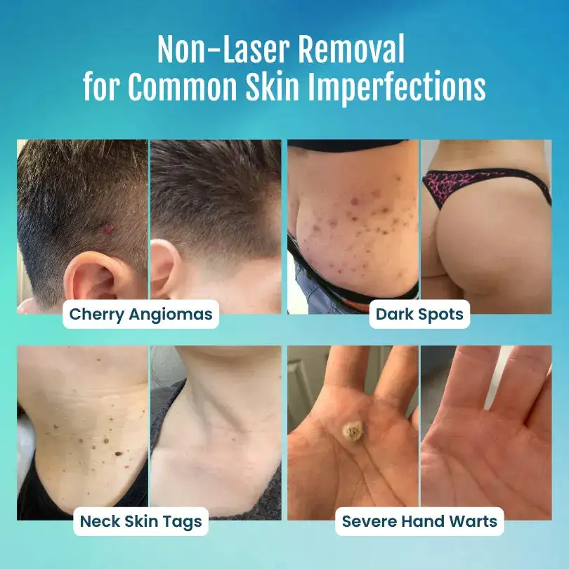 SpotlessPro Advanced Skin Care Pen - Image 3