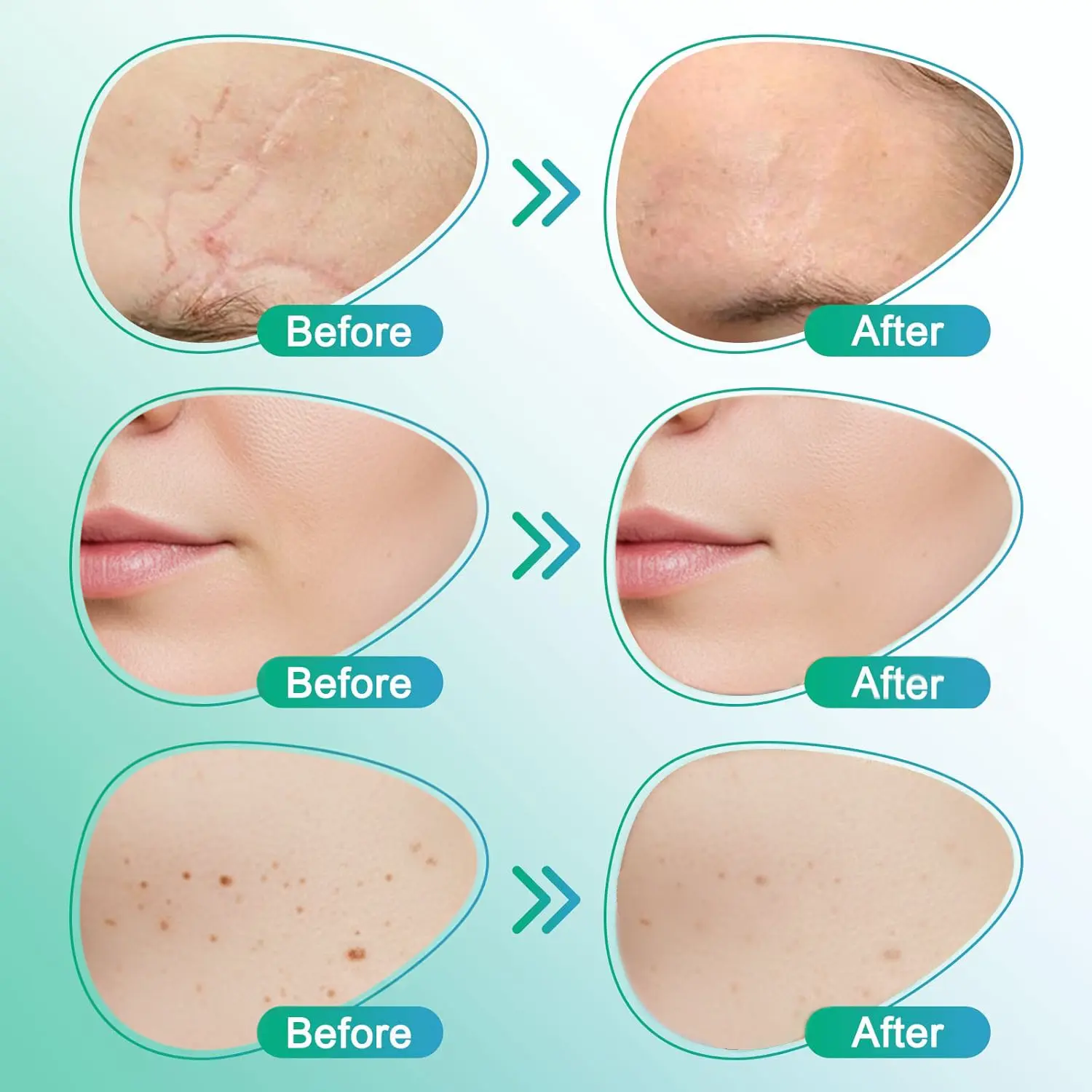 3-in-1 Scar Removal Microneedle Care Patch - Image 2