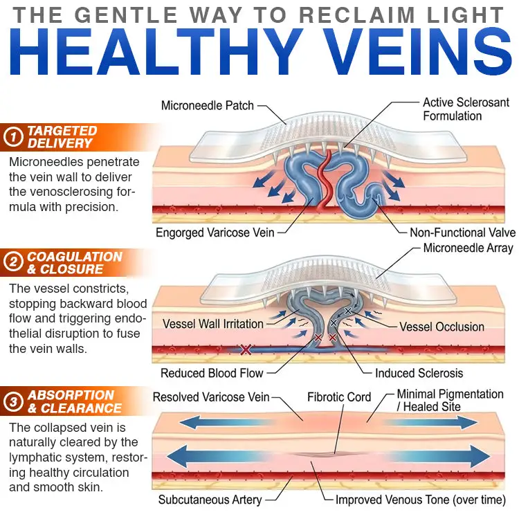 Varicose Veins Treatment Microneedle Patch - Image 7