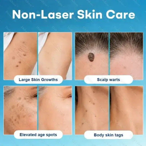 7-Day Blemish Remover Pain-Free & Scar-Free Advanced Roller Pen for Skin Tags and Spots - Image 2