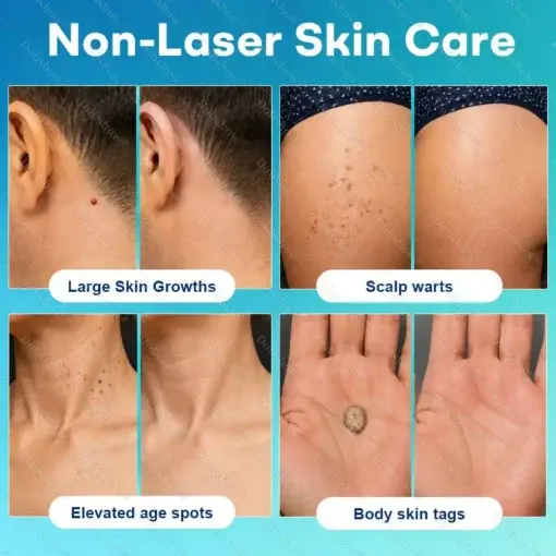 7-Day Blemish Remover Pain-Free & Scar-Free Advanced Roller Pen for Skin Tags and Spots - Image 3