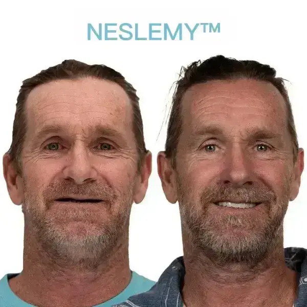 GelFit Dentures - Image 3