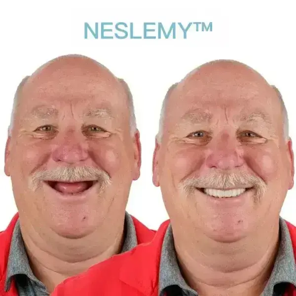 GelFit Dentures - Image 4