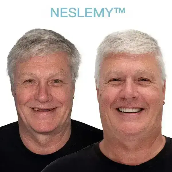 GelFit Dentures - Image 5