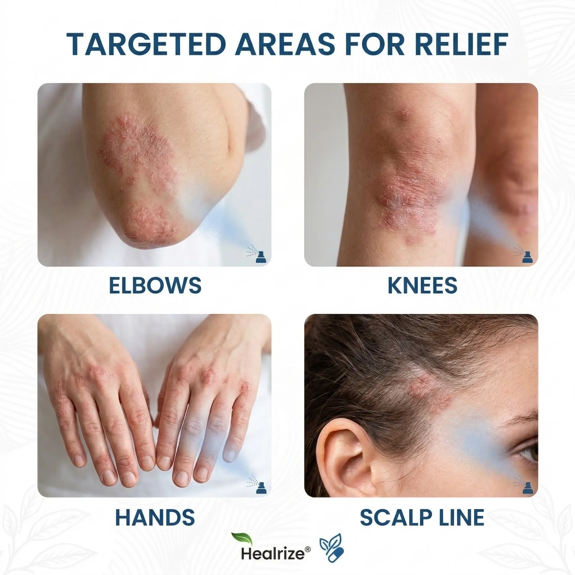 Magnesium Botanic Spray – Advanced Skin Recovery for Psoriasis & Eczema - Image 2