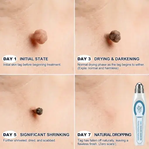 7-Day Skin Tag & Spot Eraser Painless & Scar-Free Advanced Imperfection Removal Rollerball Pen - Image 4