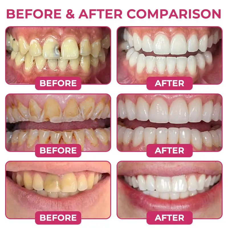 DenPerm Cavity-Repair Natural Enamel Filling Gel - Image 3