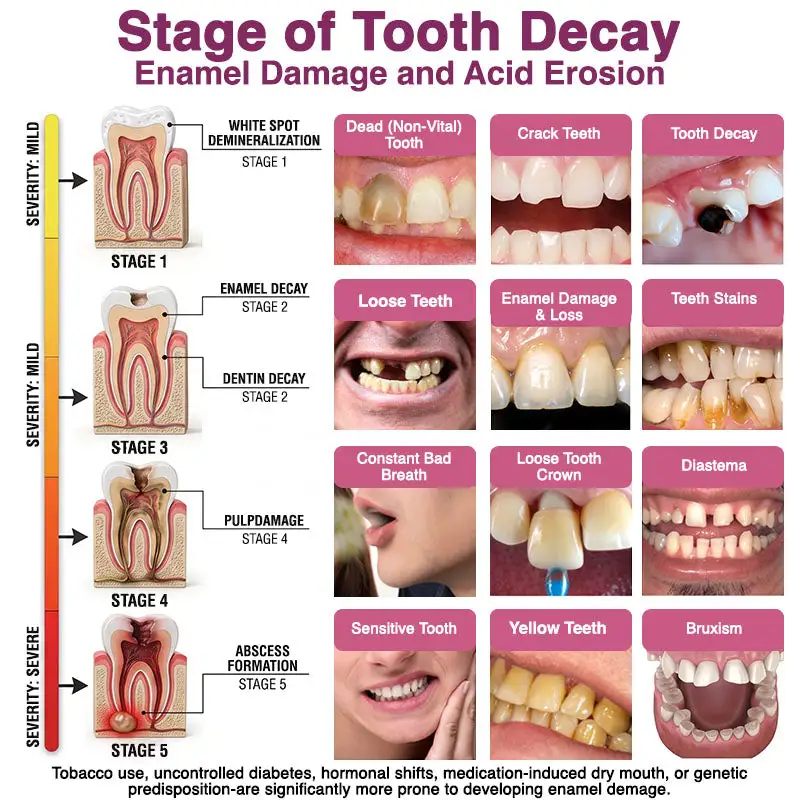 DenPerm Cavity-Repair Natural Enamel Filling Gel - Image 6